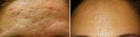 SkinPen® Microneedling Before and After Photos in Houston, TX