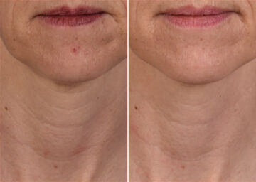 SkinPen® Microneedling Before and After Photos in Houston, TX, Patient 13660