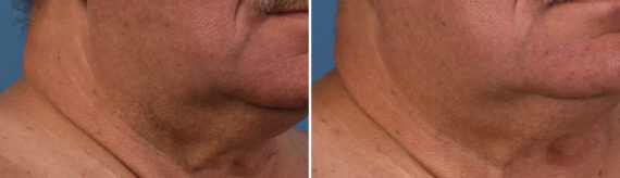 SkinPen® Microneedling Before and After Photos in Houston, TX, Patient 13656