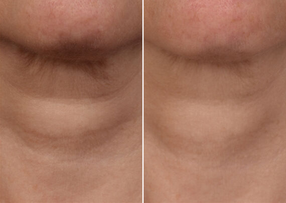 SkinPen® Microneedling Before and After Photos in Houston, TX, Patient 13654