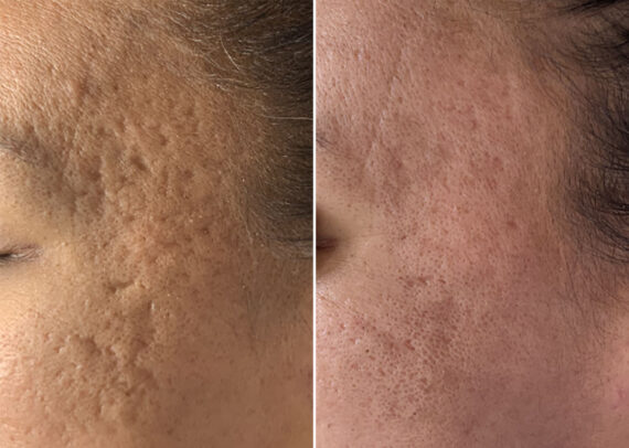 SkinPen® Microneedling Before and After Photos in Houston, TX, Patient 13638