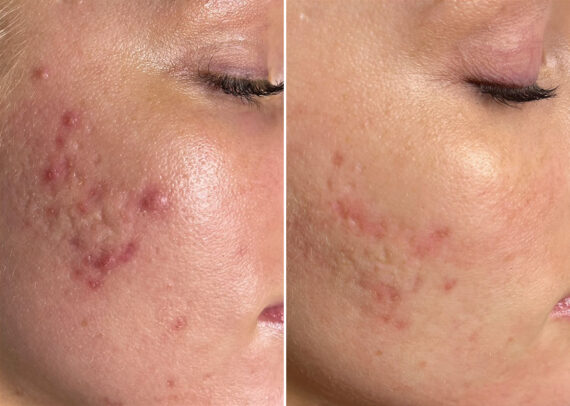 SkinPen® Microneedling Before and After Photos in Houston, TX, Patient 13631