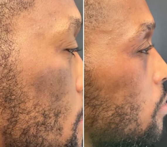SkinPen® Microneedling Before and After Photos in Houston, TX, Patient 13616