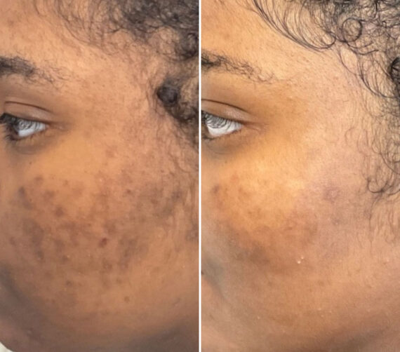 SkinPen® Microneedling Before and After Photos in Houston, TX, Patient 13626