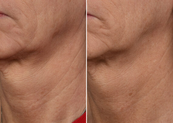 SkinPen® Microneedling Before and After Photos in Houston, TX, Patient 13646