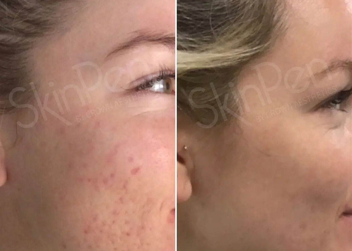 Microneedling is a unique, minimally invasive technique that rejuvenates the skin.