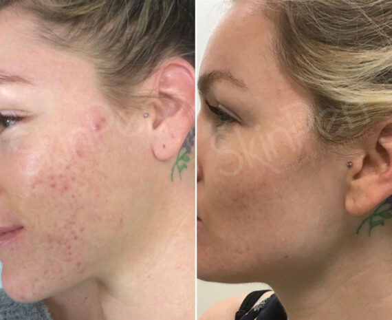 SkinPen® Microneedling Before and After Photos in Houston, TX, Patient 13686