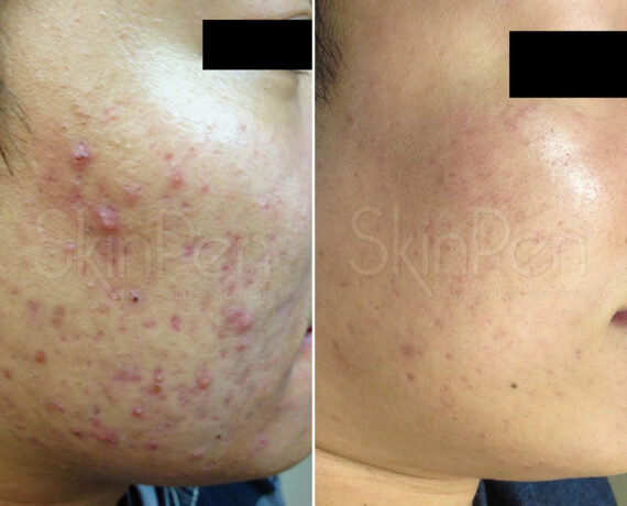 SkinPen® Microneedling Before and After Photos in Houston, TX, Patient 13697