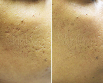 SkinPen® Microneedling Before and After Photos in Houston, TX, Patient 13693