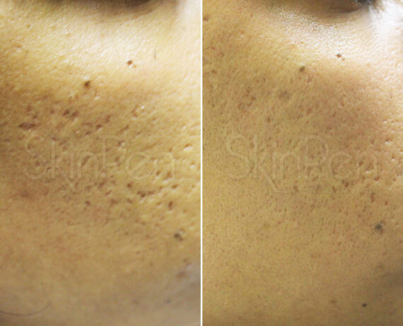 SkinPen® Microneedling Before and After Photos in Houston, TX, Patient 13693