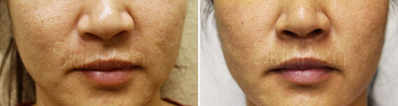 SkinPen® Microneedling Before and After Photos in Houston, TX, Patient 13682