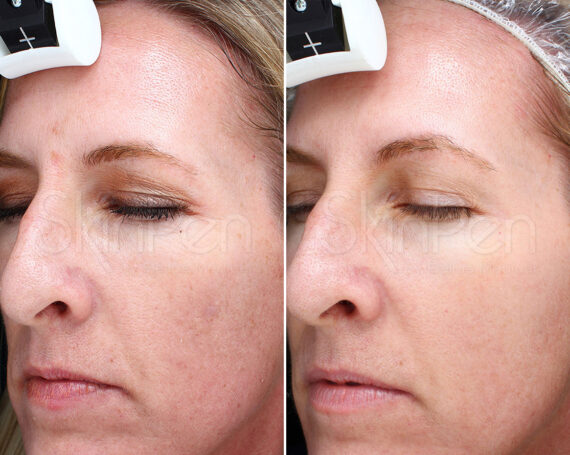 SkinPen® Microneedling Before and After Photos in Houston, TX, Patient 13678