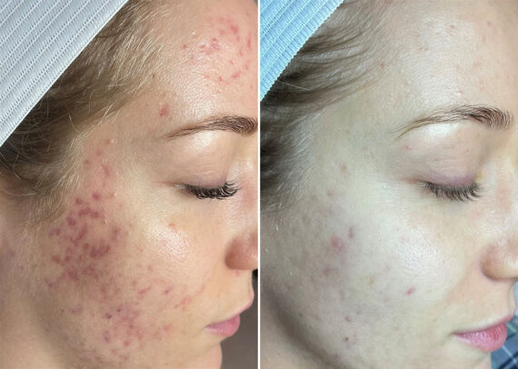 SkinPen® Microneedling Before and After Photos in Houston, TX, Patient 13664