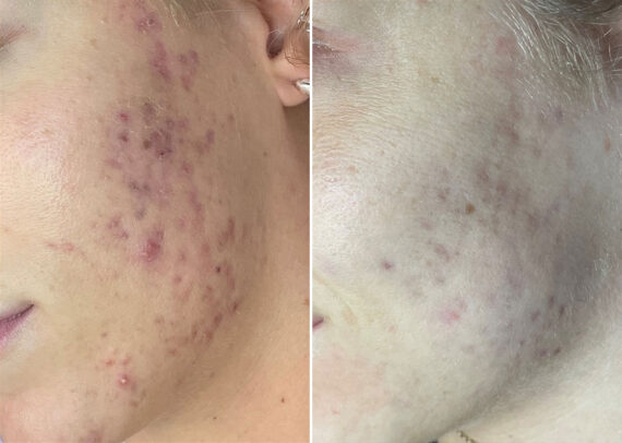 SkinPen® Microneedling Before and After Photos in Houston, TX, Patient 13664