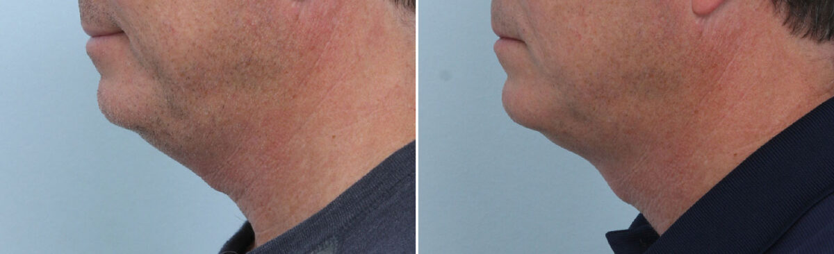 CoolSculpting Before and After Photos in Houston, TX, Patient 14002