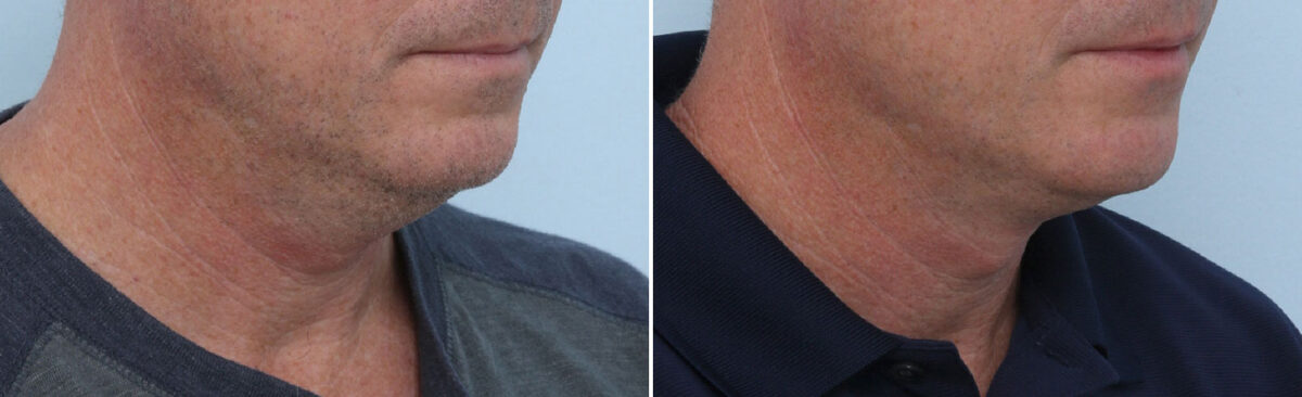 CoolSculpting Before and After Photos in Houston, TX, Patient 14002