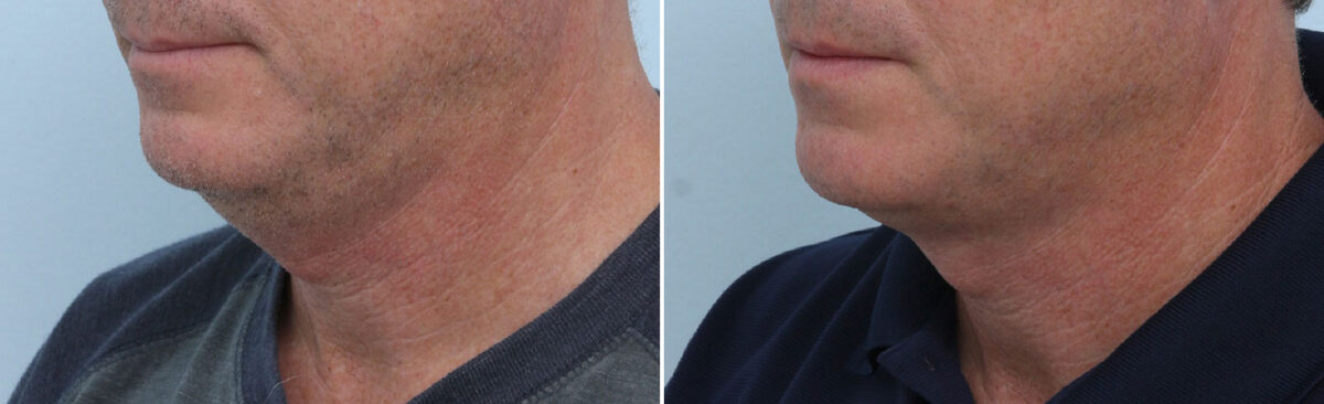 CoolSculpting Before and After Photos in Houston, TX, Patient 14002