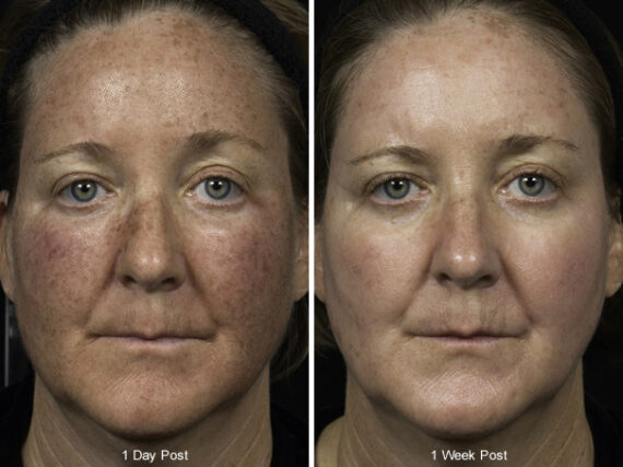 Fraxel Laser Before and After Photos in Houston, TX, Patient 7971