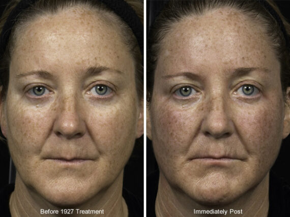 Fraxel Laser Before and After Photos in Houston, TX, Patient 7971