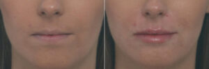 1736359243 patient 10478 lip enhancement before after 4 570x190