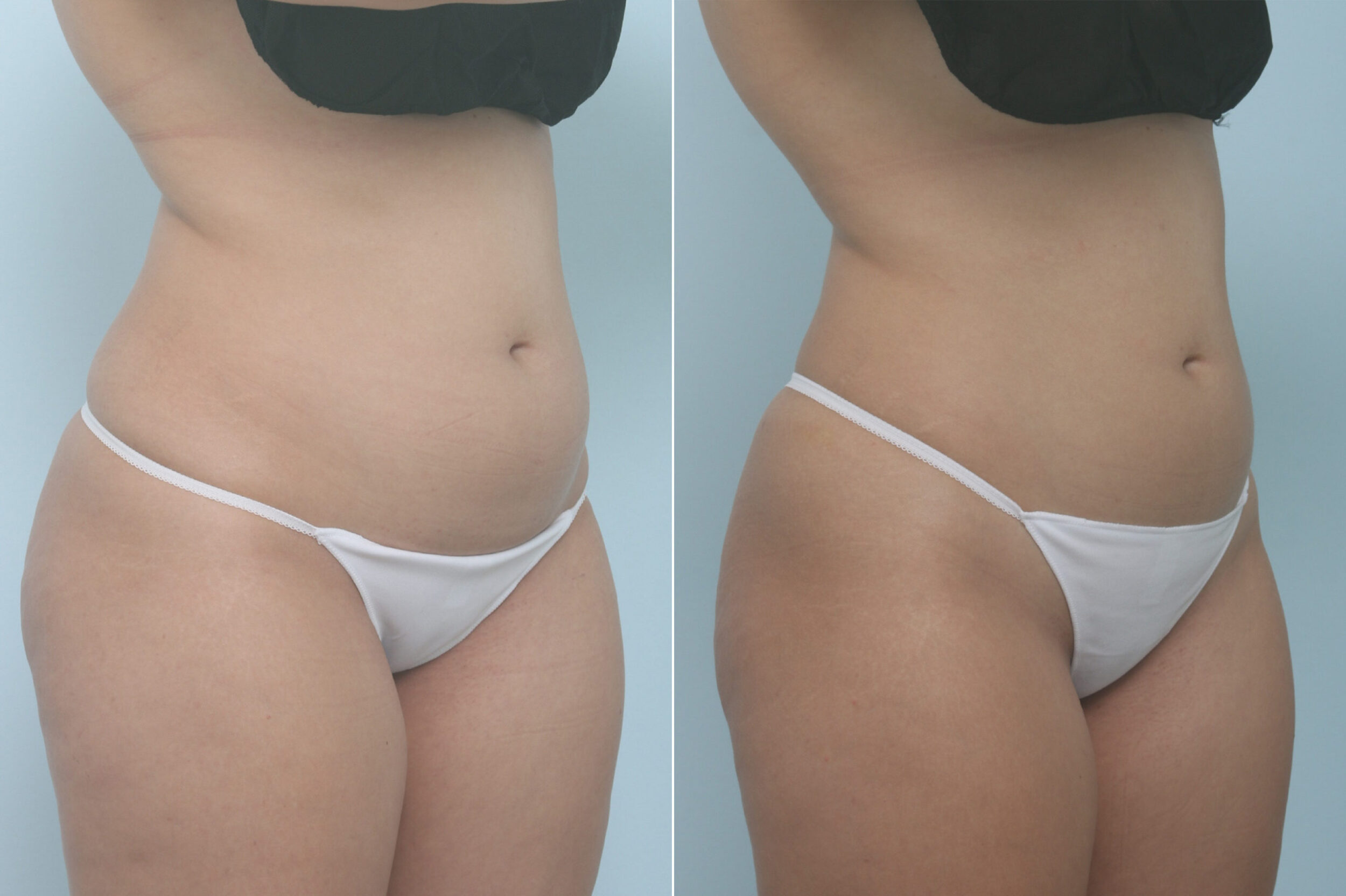 Before and After Image: CoolSculpting Before and After Photos in Houston, TX, Patient 11357 - right-front-oblique