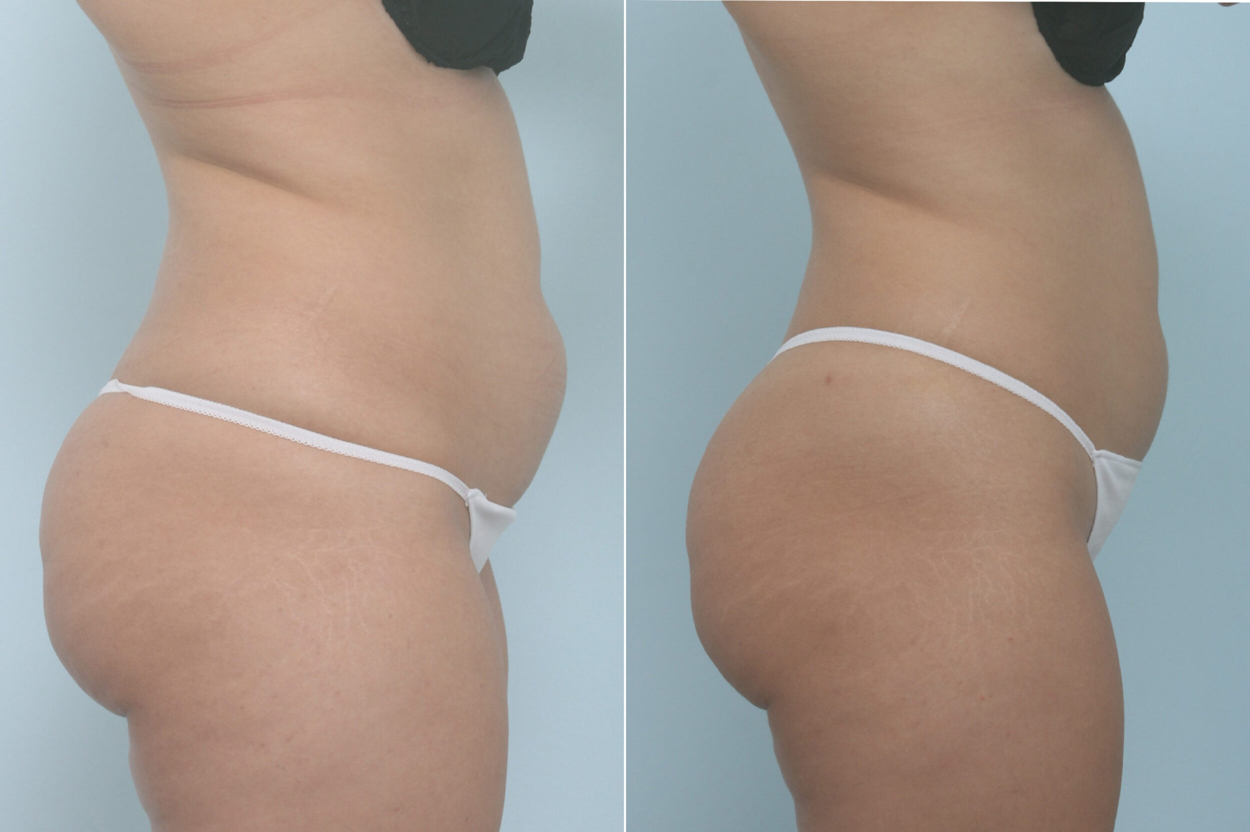 Before and After Image: CoolSculpting Before and After Photos in Houston, TX, Patient 11357 - right-side