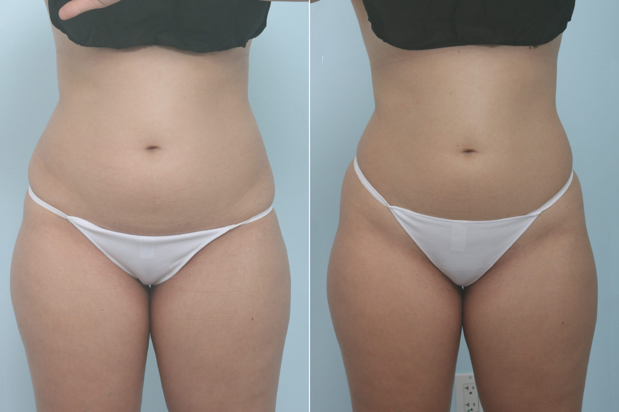 Before and After Image: CoolSculpting Before and After Photos in Houston, TX, Patient 11357 - front