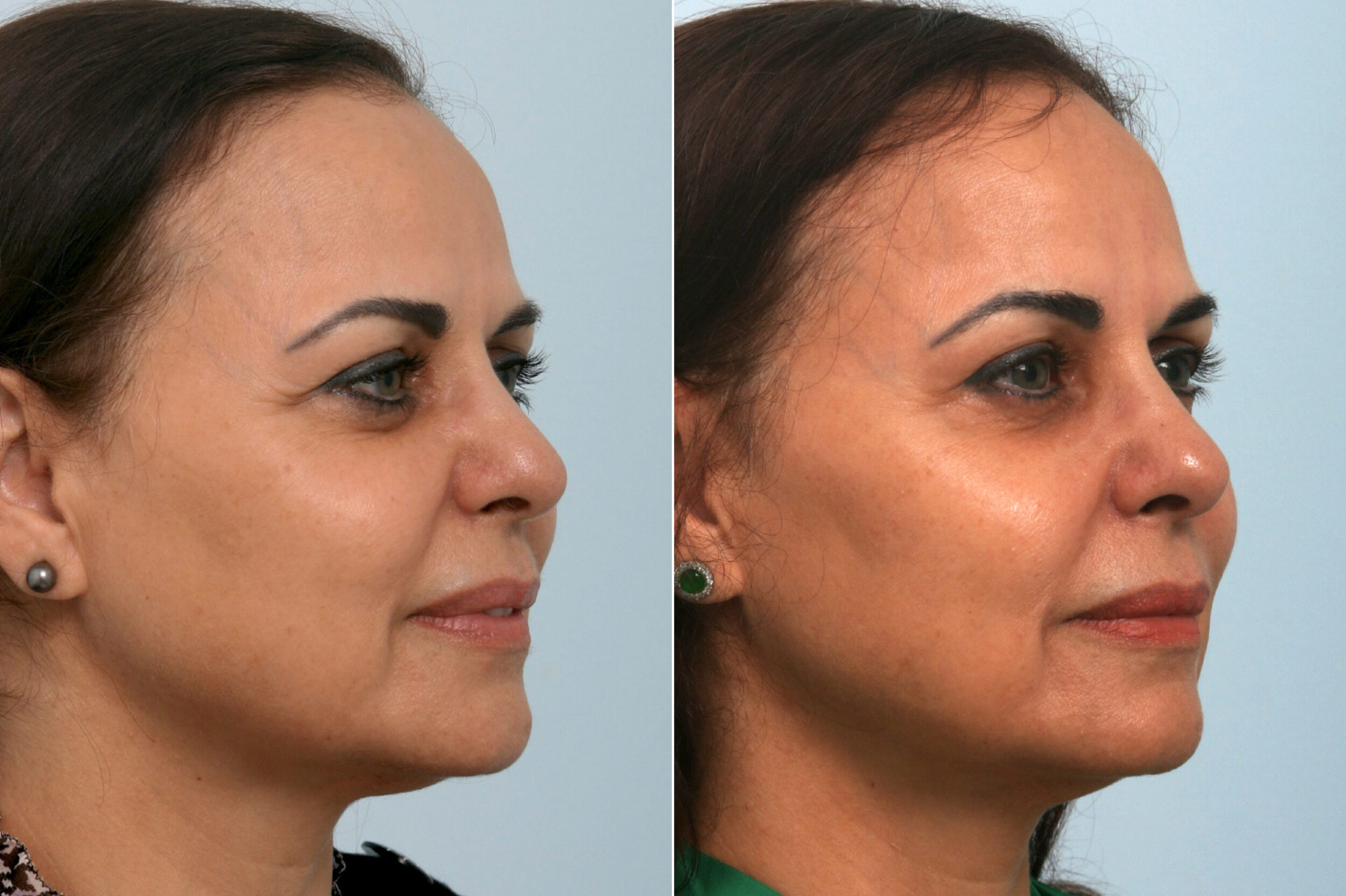 Before and After Image: Ulthera Lift Before and After Photos in Houston, TX, Patient 11408 - right-front-oblique