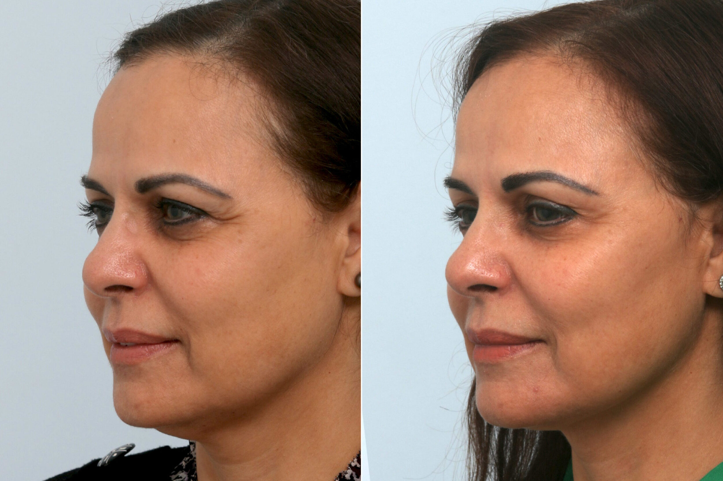 Before and After Image: Ulthera Lift Before and After Photos in Houston, TX, Patient 11408 - left-front-oblique