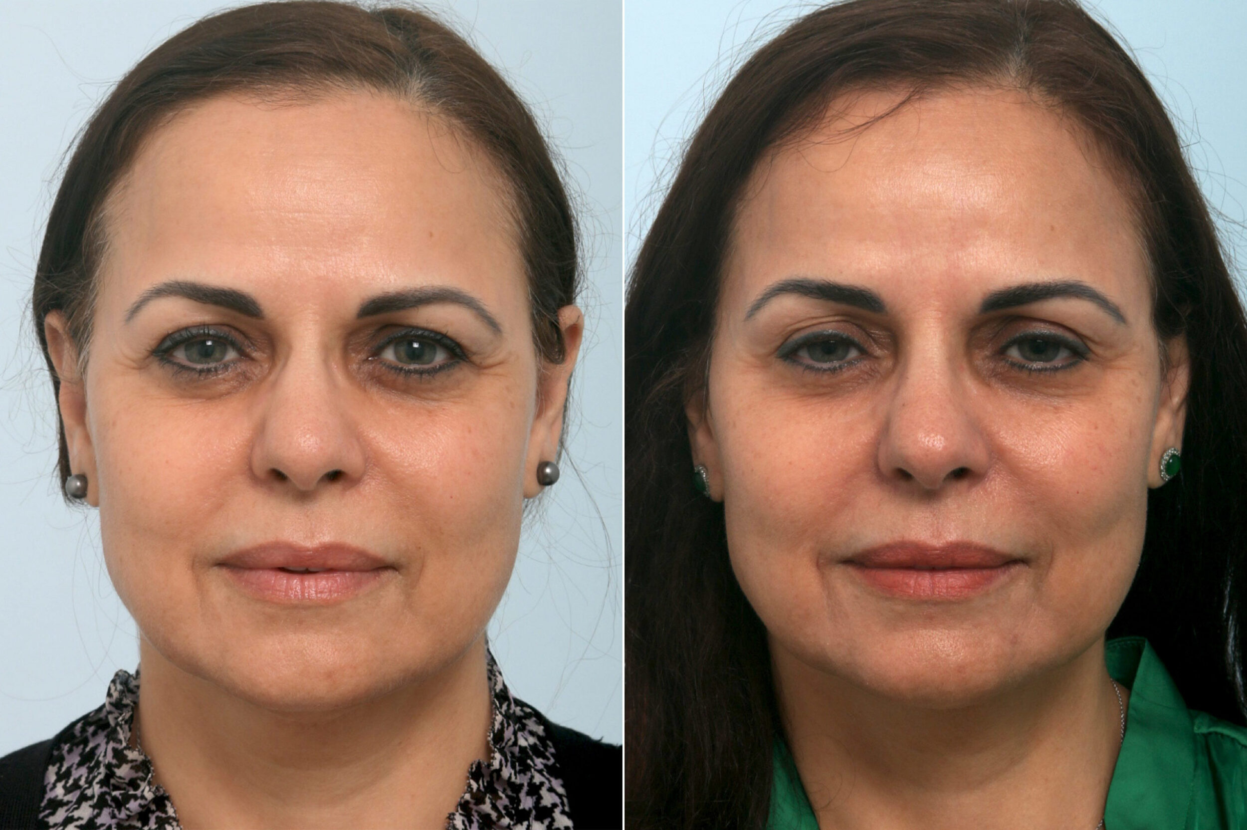 Before and After Image: Ulthera Lift Before and After Photos in Houston, TX, Patient 11408 - front