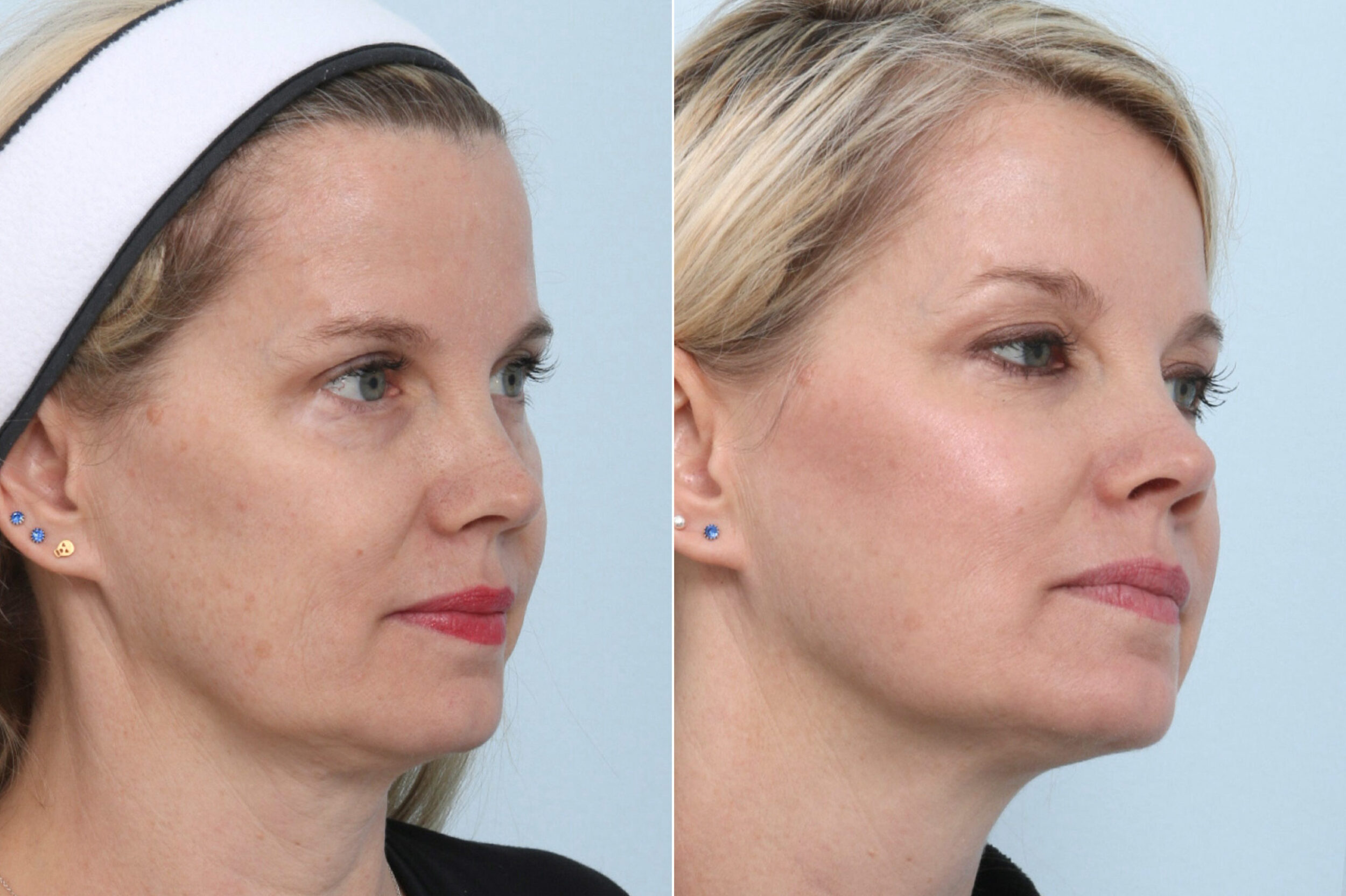 Before and After Image: Ulthera Lift Before and After Photos in Houston, TX, Patient 11582 - right-front-oblique