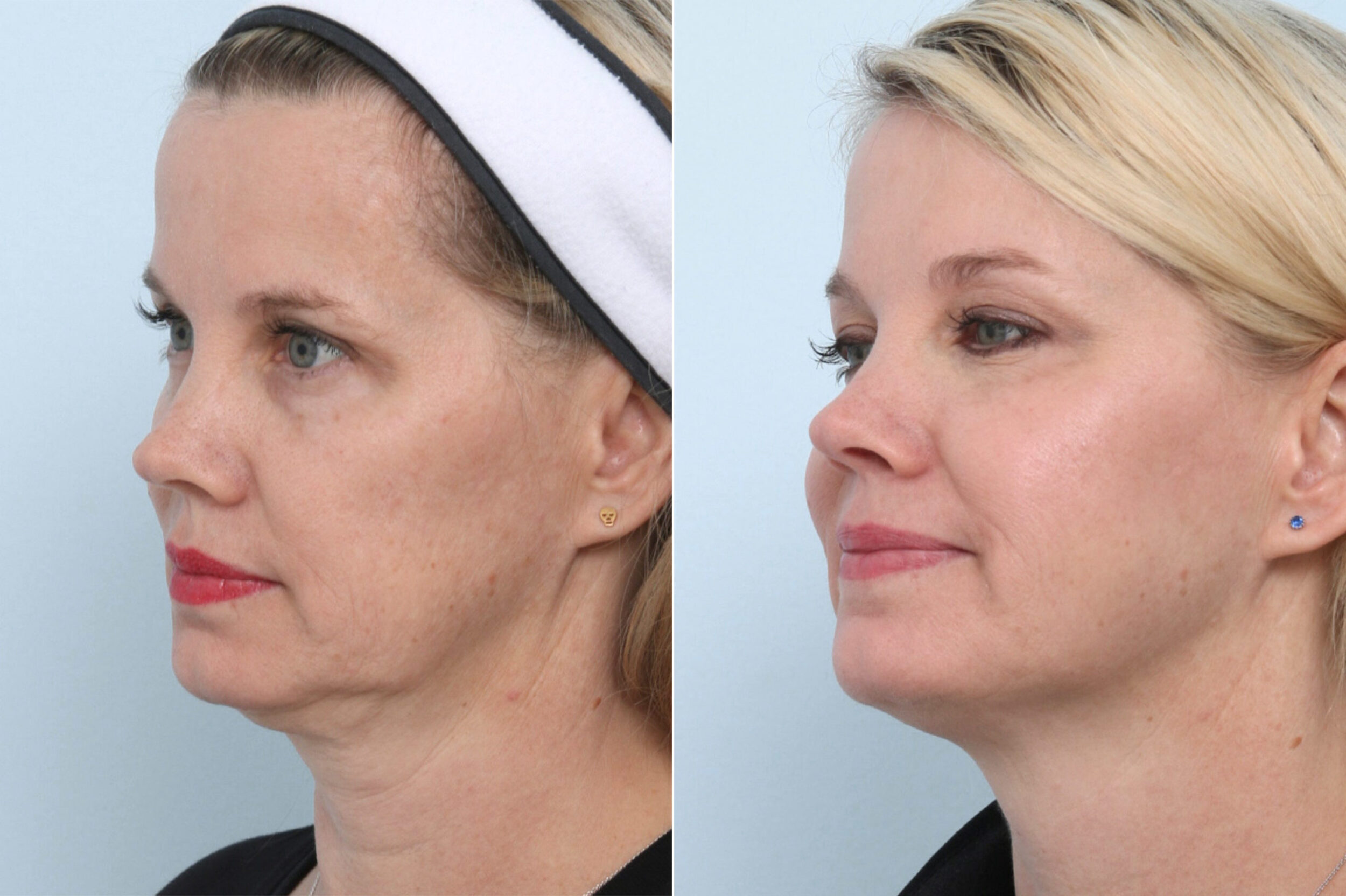 Before and After Image: Ulthera Lift Before and After Photos in Houston, TX, Patient 11582 - left-front-oblique