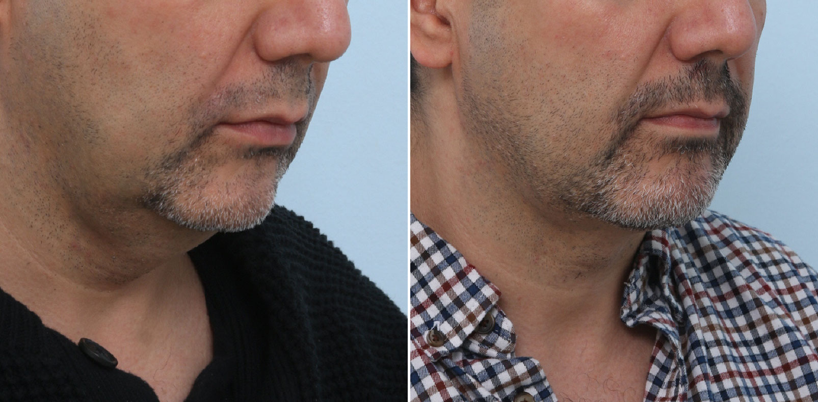 Before and After Image: Ulthera Lift Before and After Photos in Houston, TX, Patient 13884 - right-front-oblique