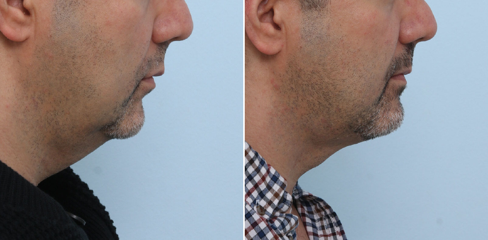 Before and After Image: Ulthera Lift Before and After Photos in Houston, TX, Patient 13884 - right-side