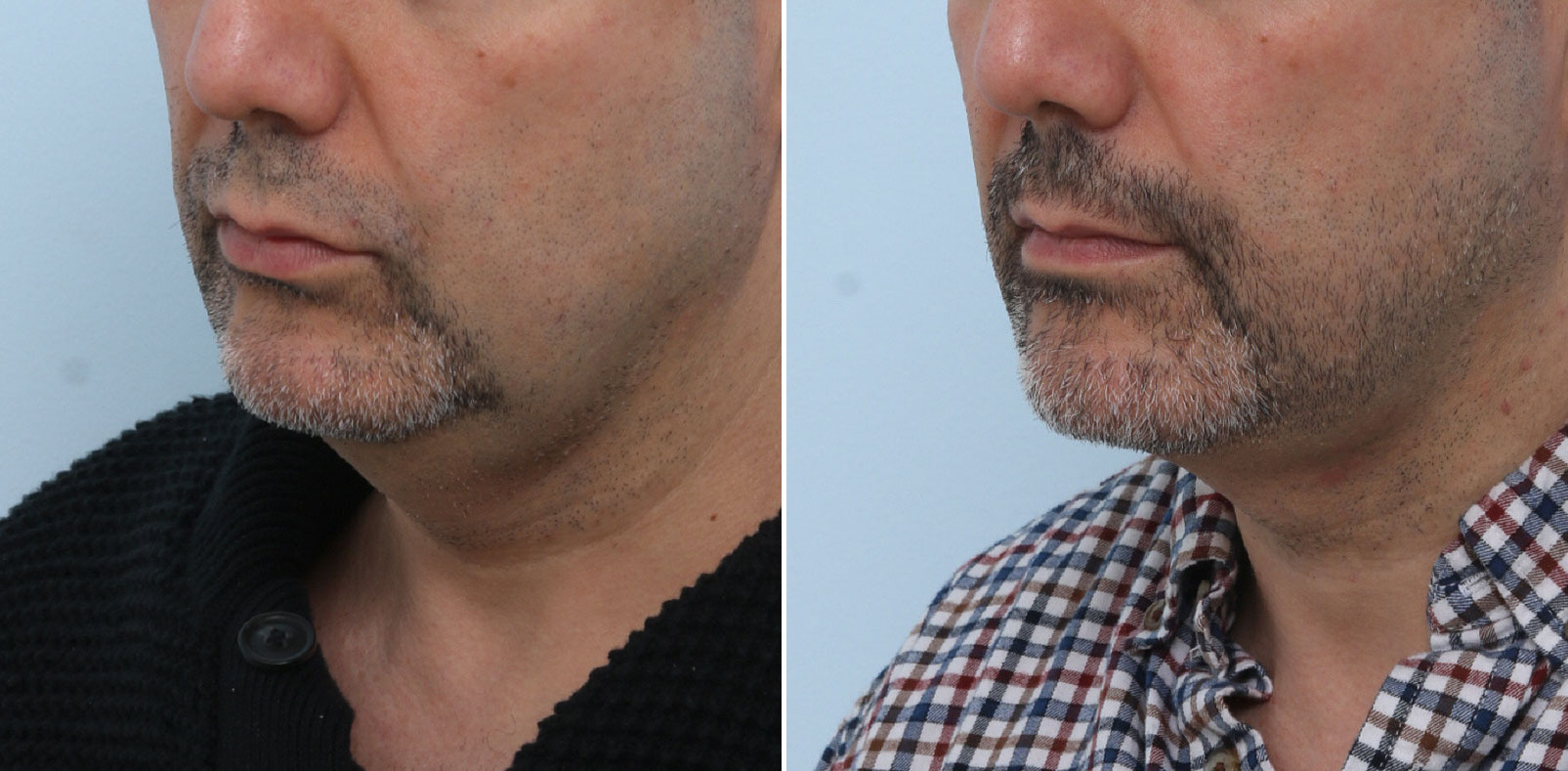 Before and After Image: Ulthera Lift Before and After Photos in Houston, TX, Patient 13884 - left-front-oblique