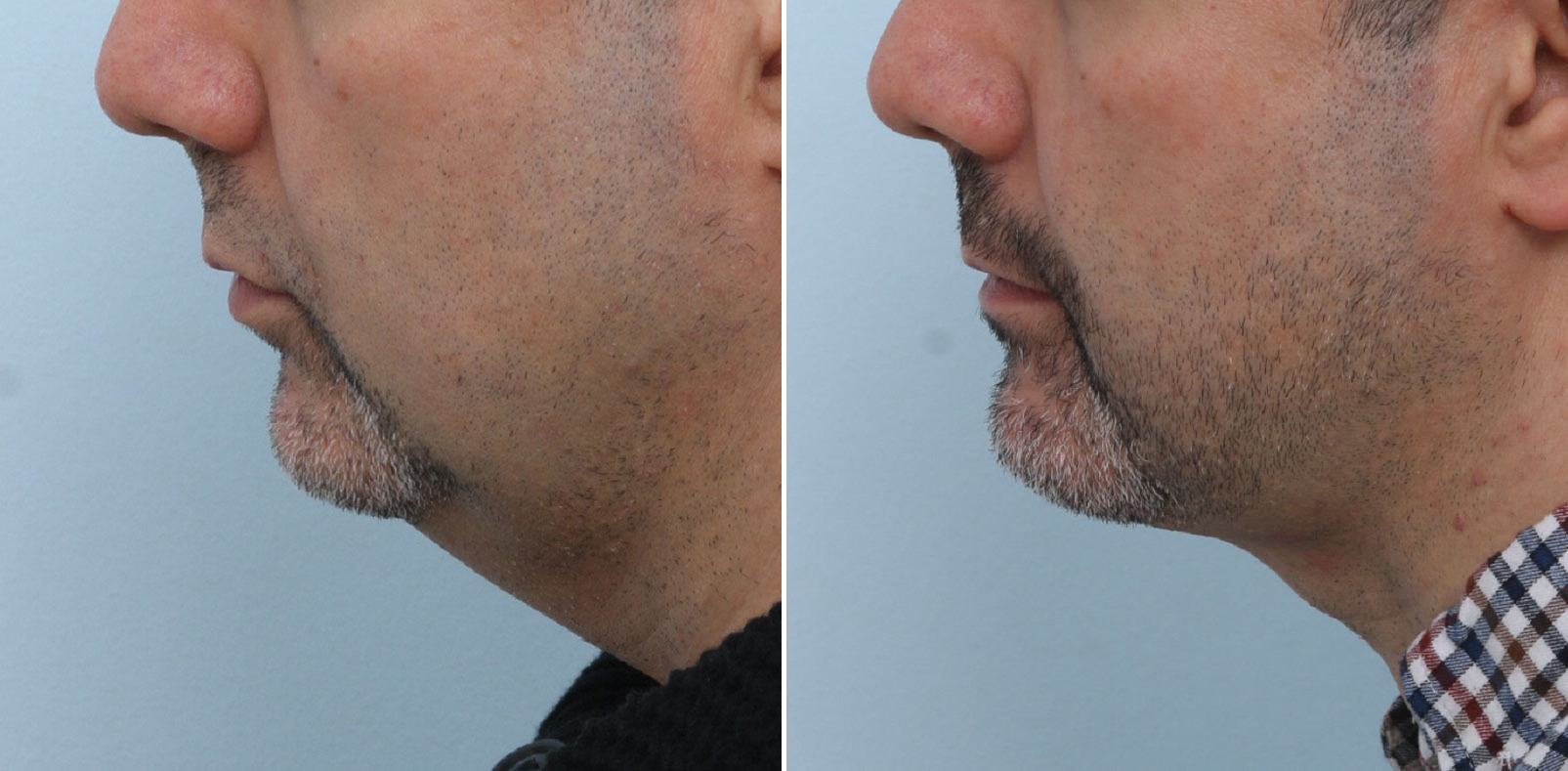 Before and After Image: Ulthera Lift Before and After Photos in Houston, TX, Patient 13884 - left-side