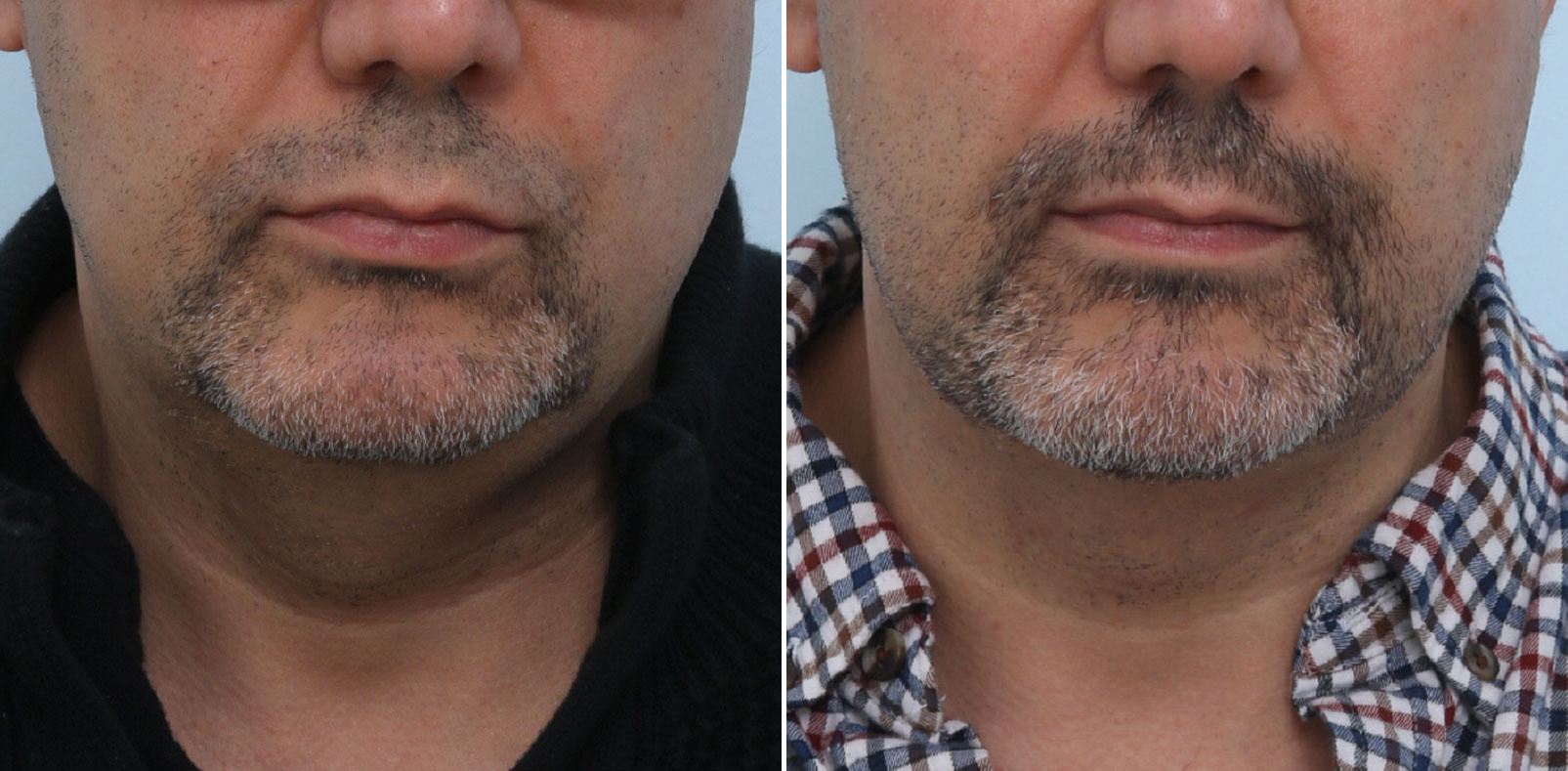 Before and After Image: Ulthera Lift Before and After Photos in Houston, TX, Patient 13884 - front