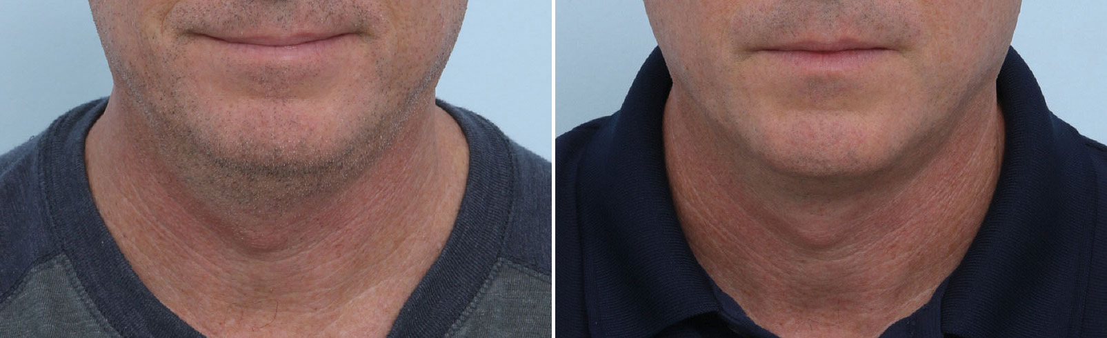 Before and After Image: CoolSculpting Before and After Photos in Houston, TX, Patient 14002 - front