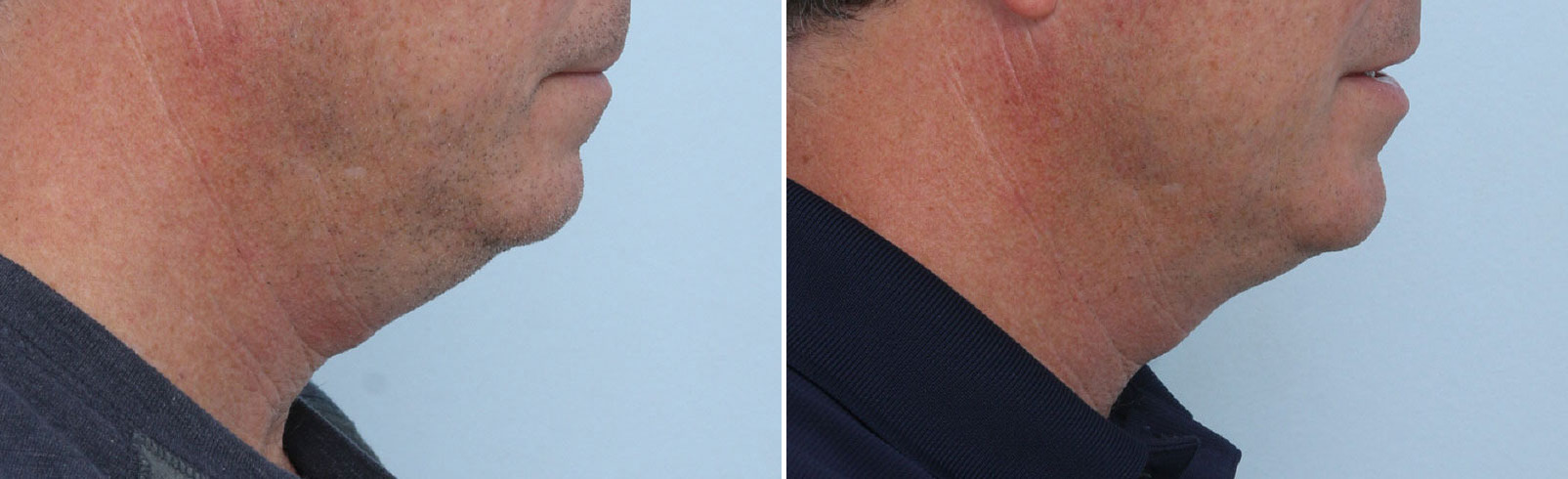 Before and After Image: CoolSculpting Before and After Photos in Houston, TX, Patient 14002 - right-side