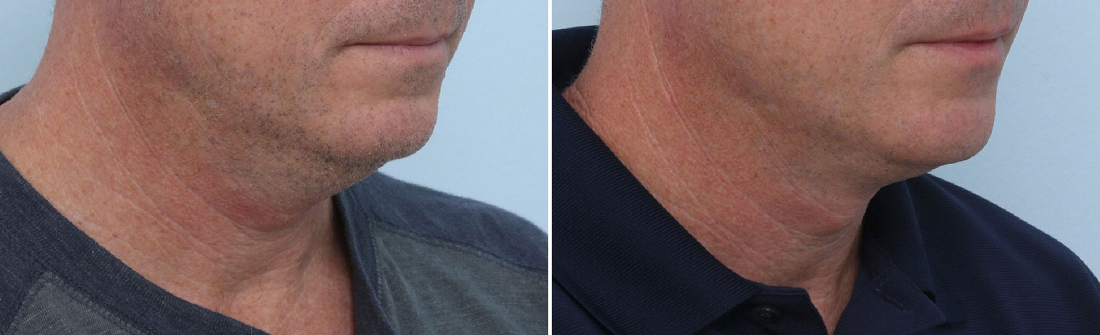 Before and After Image: CoolSculpting Before and After Photos in Houston, TX, Patient 14002 - right-front-oblique