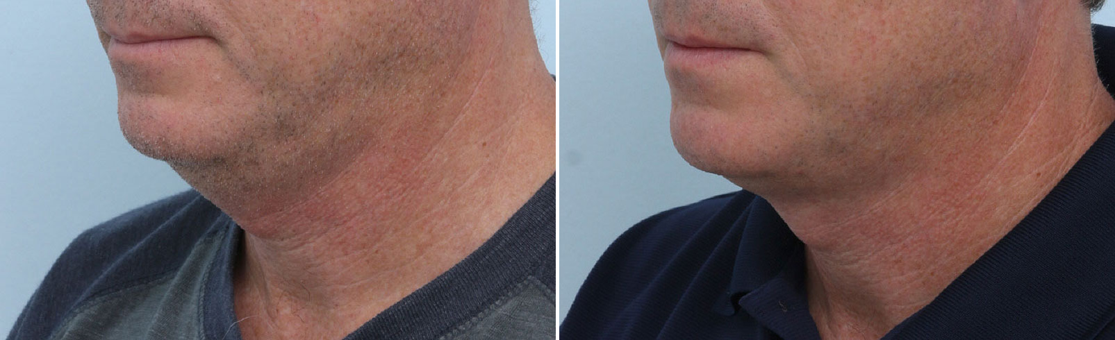 Before and After Image: CoolSculpting Before and After Photos in Houston, TX, Patient 14002 - left-front-oblique