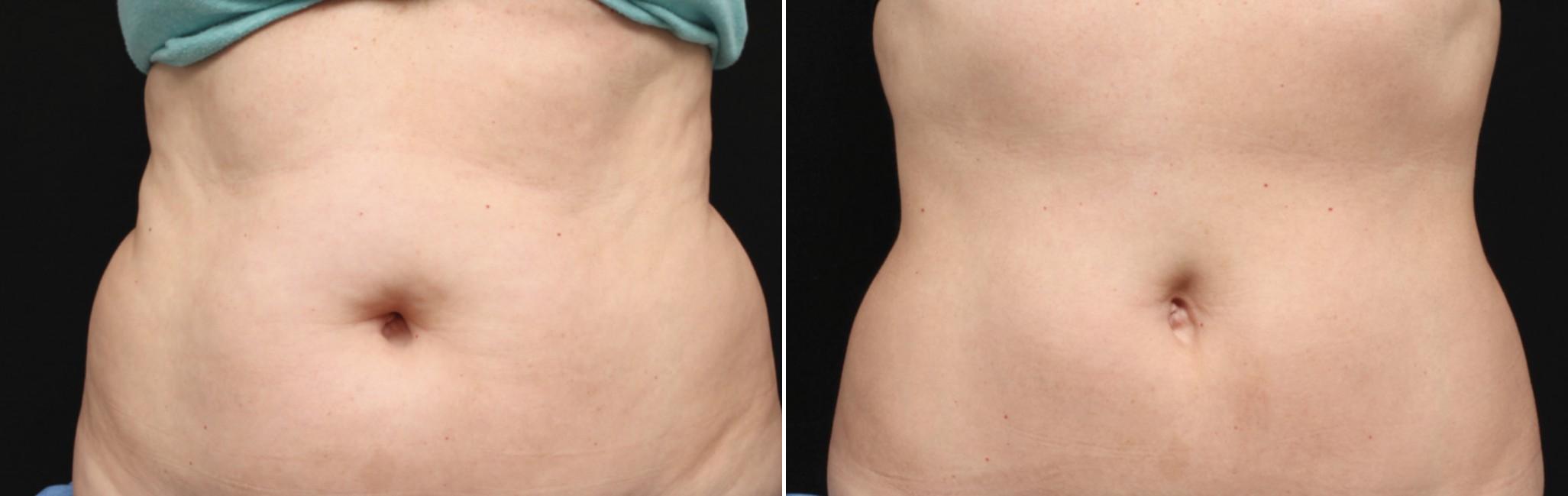 Before and After Image: CoolSculpting Before and After Photos in Houston, TX, Patient 7808 - front