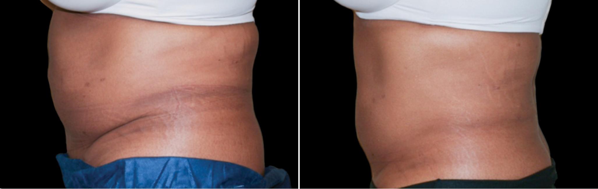 Before and After Image: CoolSculpting Before and After Photos in Houston, TX, Patient 7822 - left-side