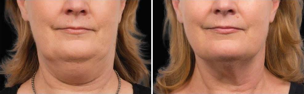 Before and After Image: CoolSculpting Before and After Photos in Houston, TX, Patient 7870 - front