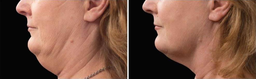 Before and After Image: CoolSculpting Before and After Photos in Houston, TX, Patient 7870 - left-side