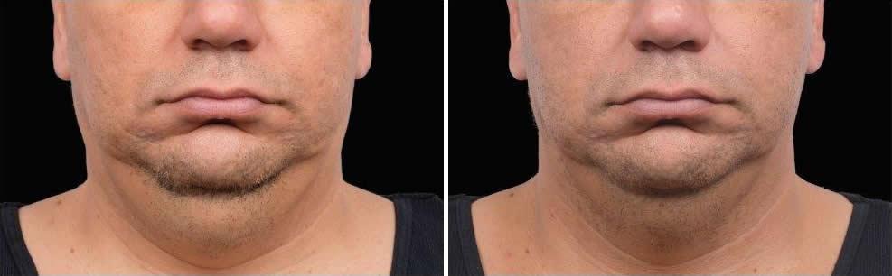 Before and After Image: CoolSculpting Before and After Photos in Houston, TX, Patient 7875 - front