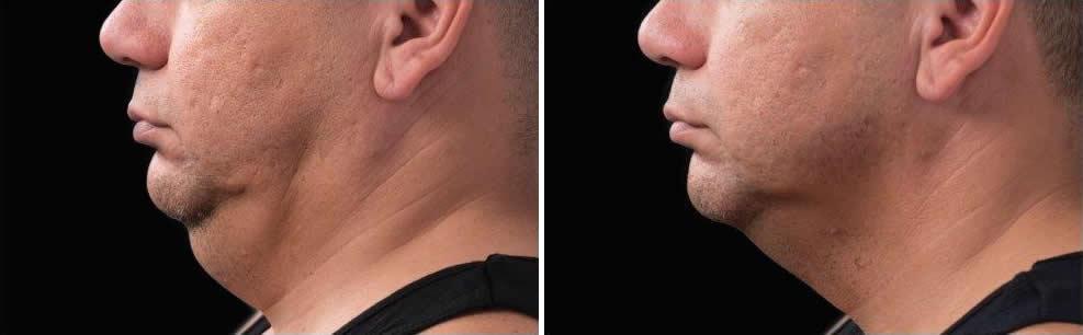 Before and After Image: CoolSculpting Before and After Photos in Houston, TX, Patient 7875 - front