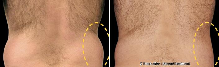 Before and After Image: CoolSculpting Before and After Photos in Houston, TX, Patient 7859 - back