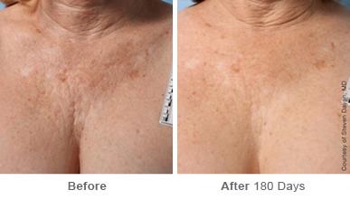 Before and After Image: Ulthera Lift Before and After Photos in Houston, TX, Patient 8179 - front