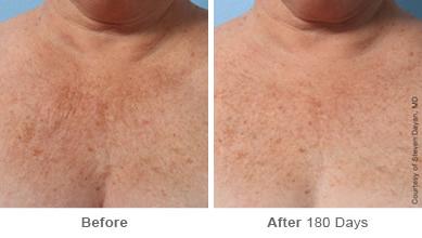 Before and After Image: Ulthera Lift Before and After Photos in Houston, TX, Patient 8176 - front